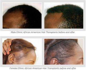 African American Hair Transplants